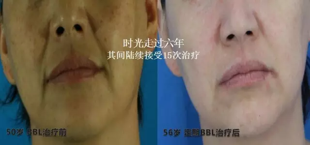 BBL光子嫩肤最新款,变化的力量,自信之源与成就感的体现